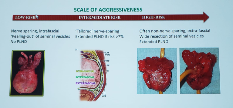 UroToday ESOU19 scale of aggressiveness