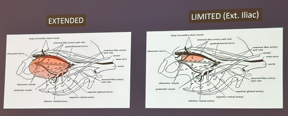 Aua 2023 Role And Extent Of Pelvic Lymph Node Dissection In Psma Era 8167