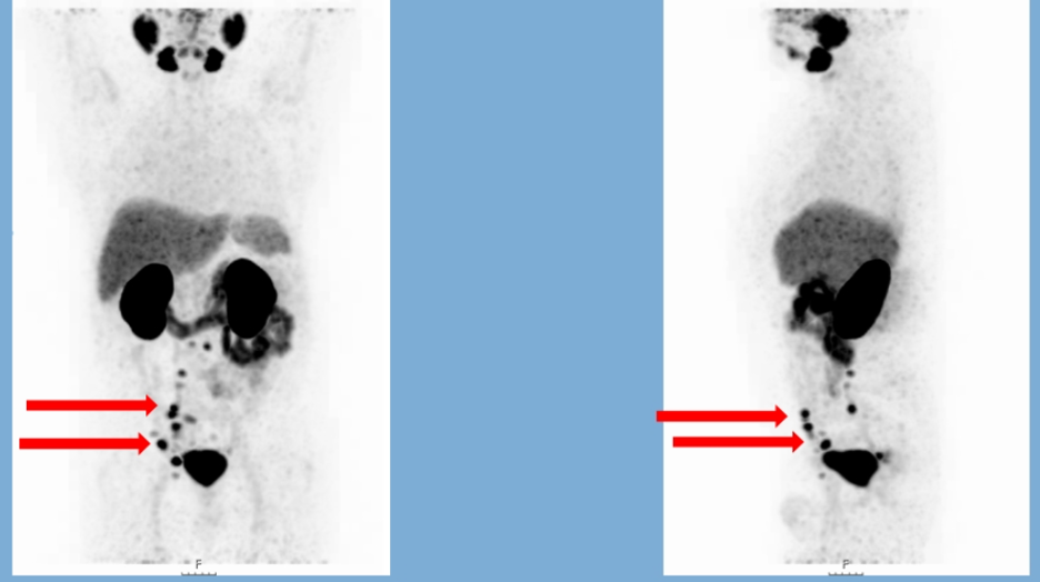 EAU2020_PSMA-targeted_Radioligand_Therapy_1.png