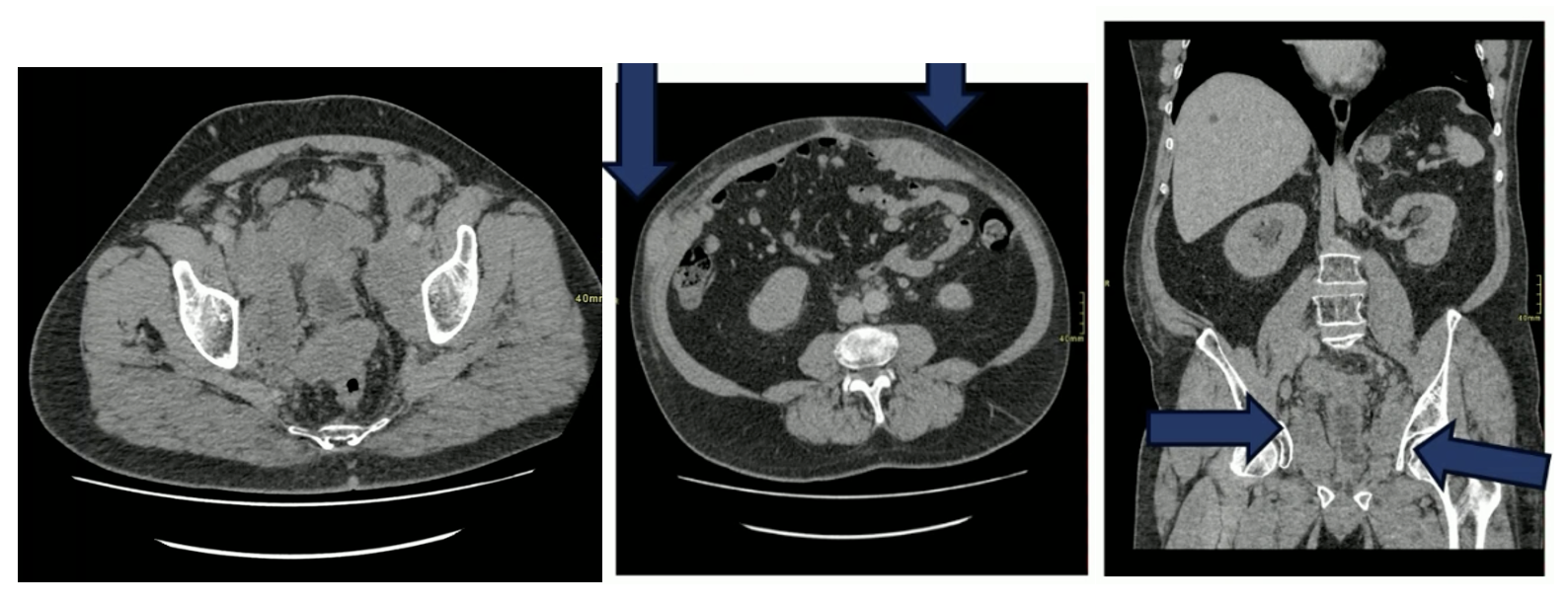 ESMO_2024_Syed_A._Hussain_Bladder_Variants.png