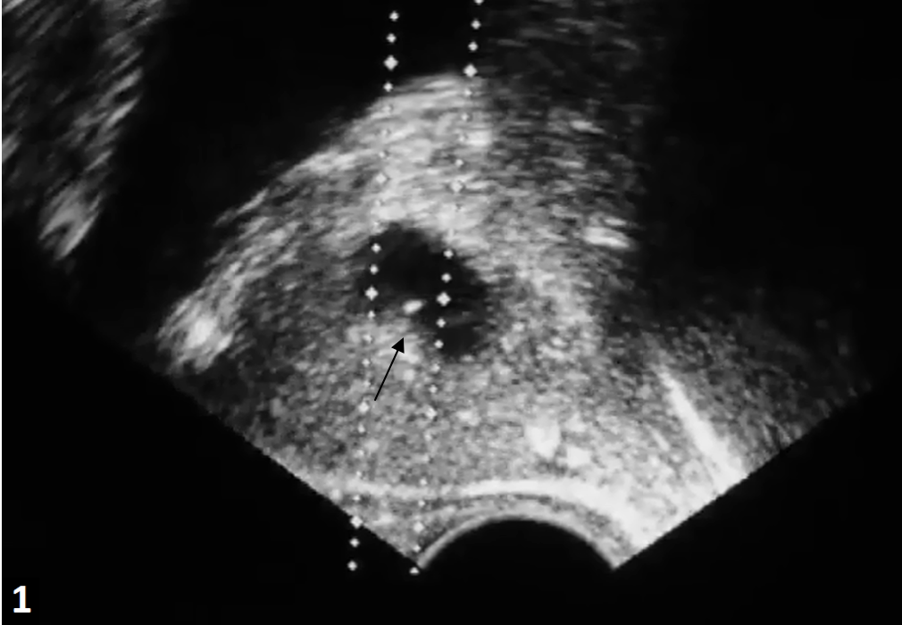 Fig1 TRUS image from BPH patient