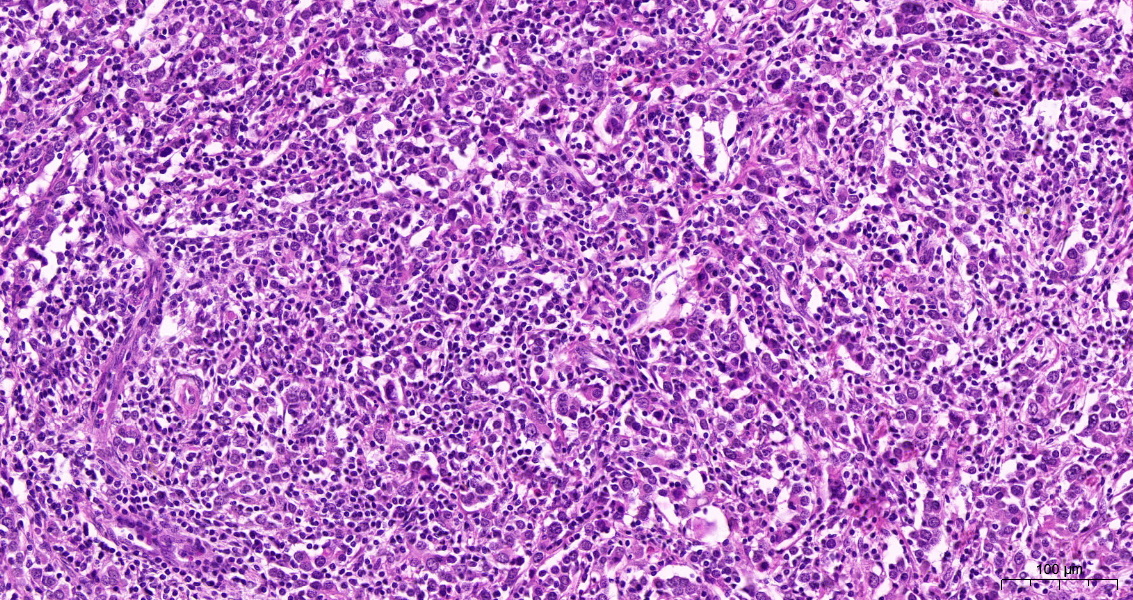 syncycial growth of the tumor cells