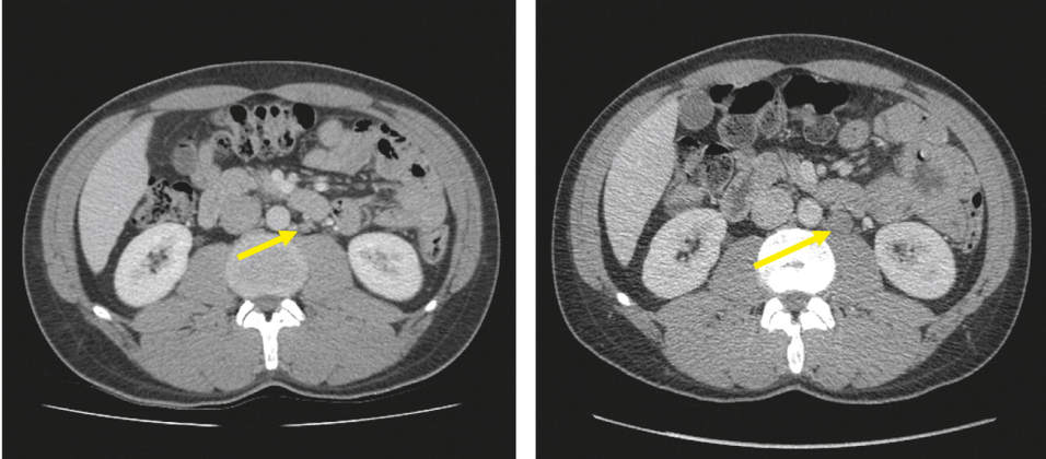 GSRGT_CS_IIa_seminoma.png