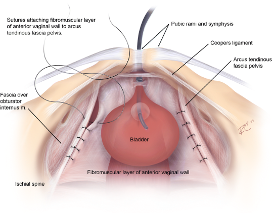 Laparoscopic_Paravaginal_repair.jpeg