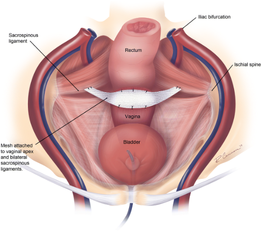 Laparoscopic_Sacrospinous_Ligament_Fixations.jpeg