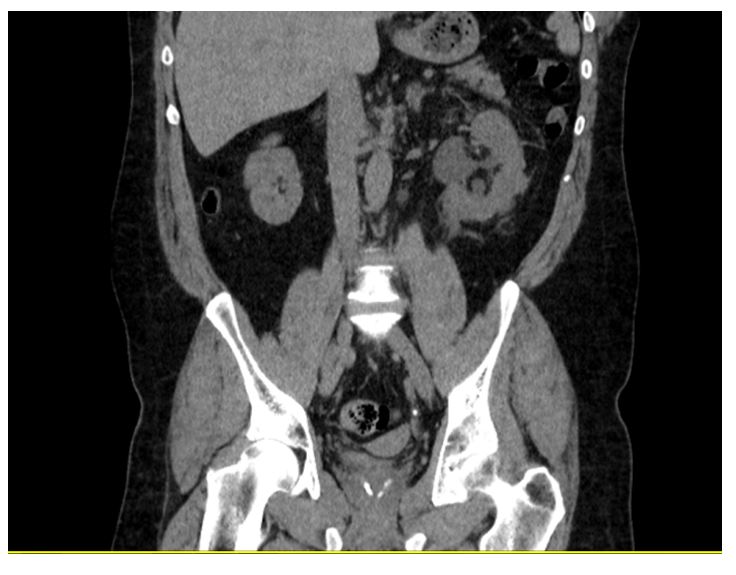 PMDR case report figure 1