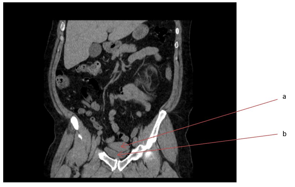 PMDR case report figure 2