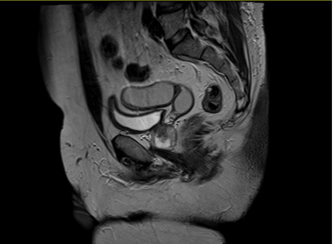 PMDR case report figure 3