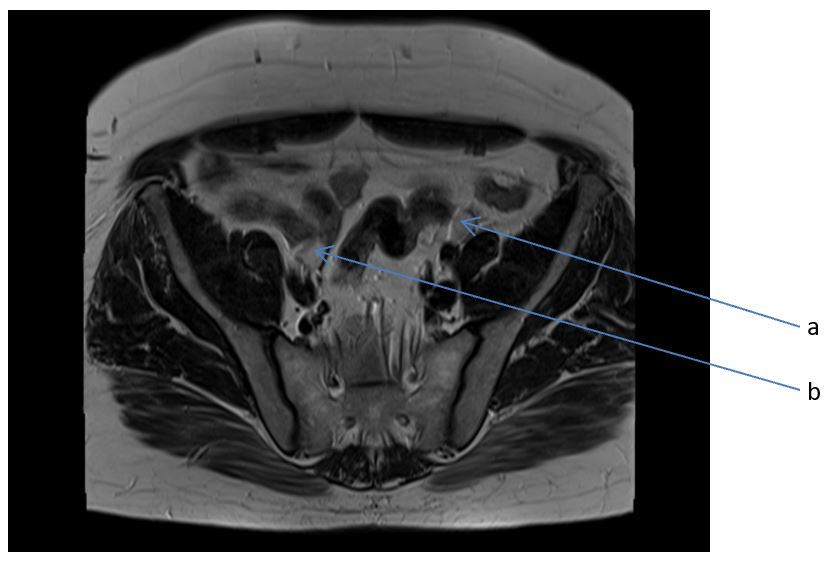 PMDR case report figure 4