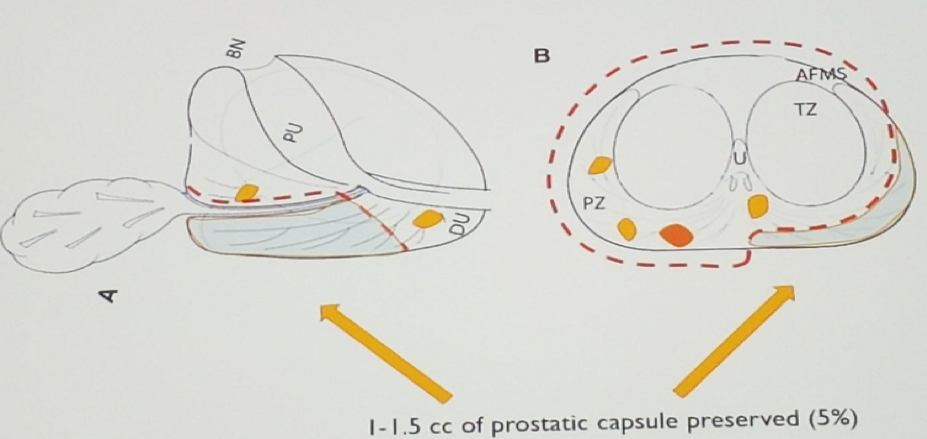 Precision prostatectomy1