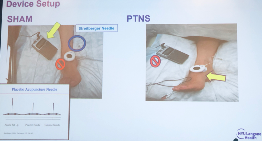 SUFU 2019 Randomized Controlled Trial Of PTNS Versus Sham Efficacy In 