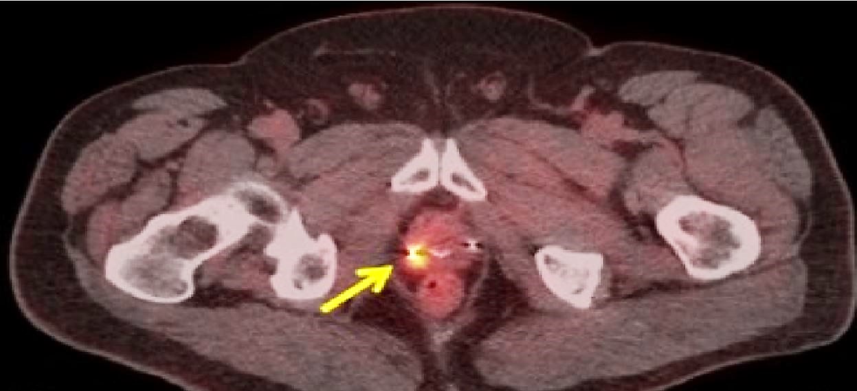 SIU 2019 F fluciclovine PET CT Imaging