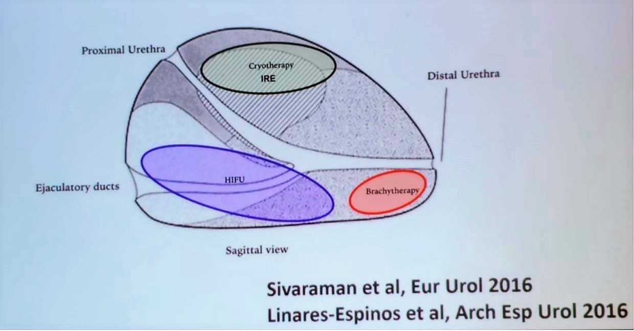 SIU 2019 focal therapy prostate tumor location
