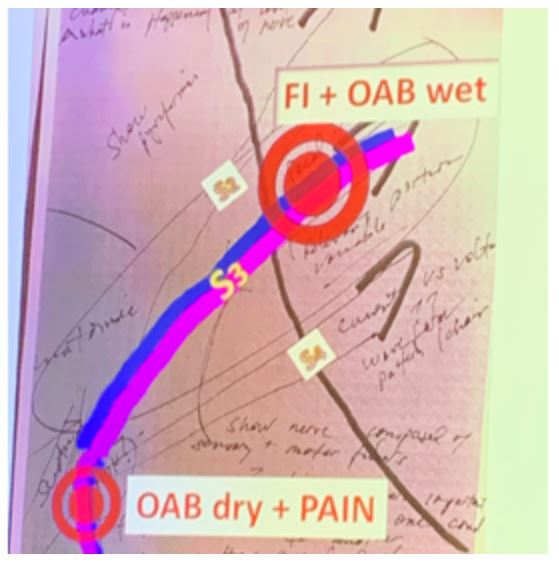 SUFU 2020 nueromodulation sacral OAB wet vs dry