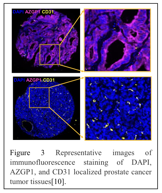 inverse correlation between AZGP1 expression and microvessel density in a human tissue microarray of localized prostate cancer