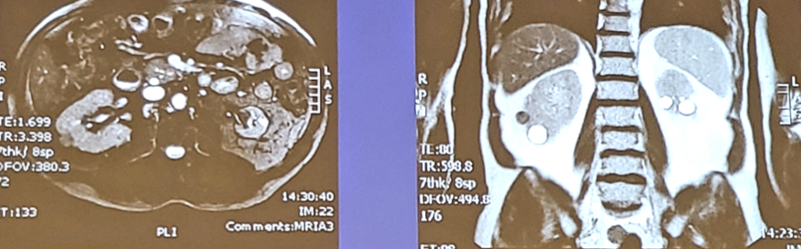 UroToday_ASCOGU2019-Kidney Cancer Case-Based Panel- Localized Disease - 4.png