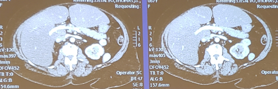 UroToday_ASCOGU2019-Kidney Cancer Case-Based Panel- Localized Disease - 5.png