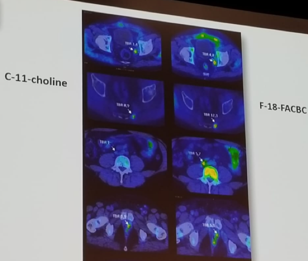 UroToday EAUPCa18 Comparison of choline and fluciclovine PETCT imaging