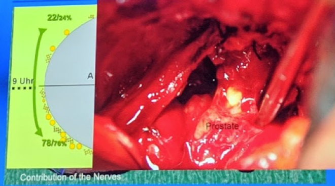 UroToday ESOU19 Optimizing functional outcomes in radical cystectomy 2