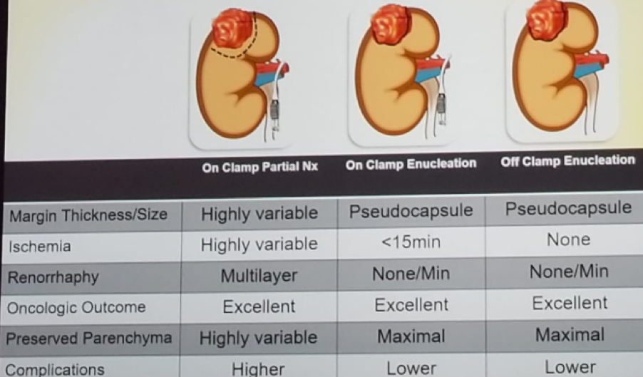 UroToday Enucleo Resection vs. Wedge Resection for Partial Nephrectomy