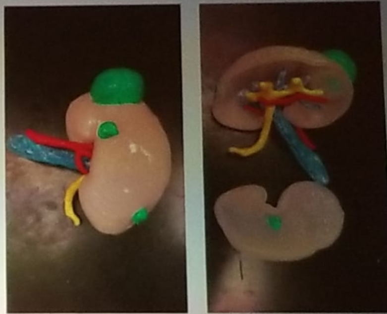 UroToday NARUS 2019 Printed 3D models