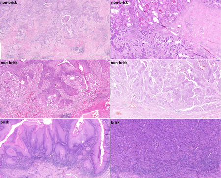 big-Figure_2_lymphocytic_rim.png