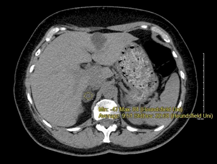 Conn’s Syndrome-1.jpg