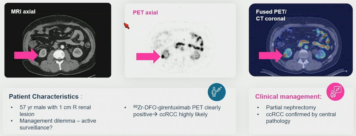 89Zr-DFO-girentuximab scan.jpg