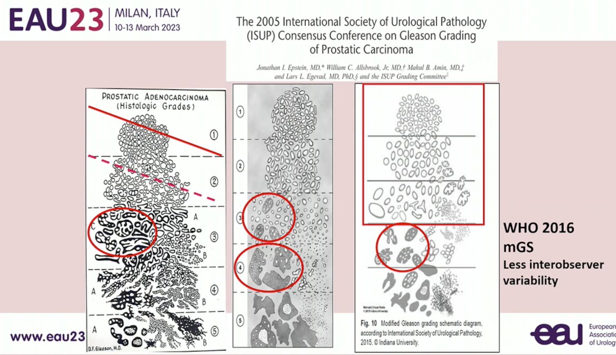 prostatic carcinoma.jpg