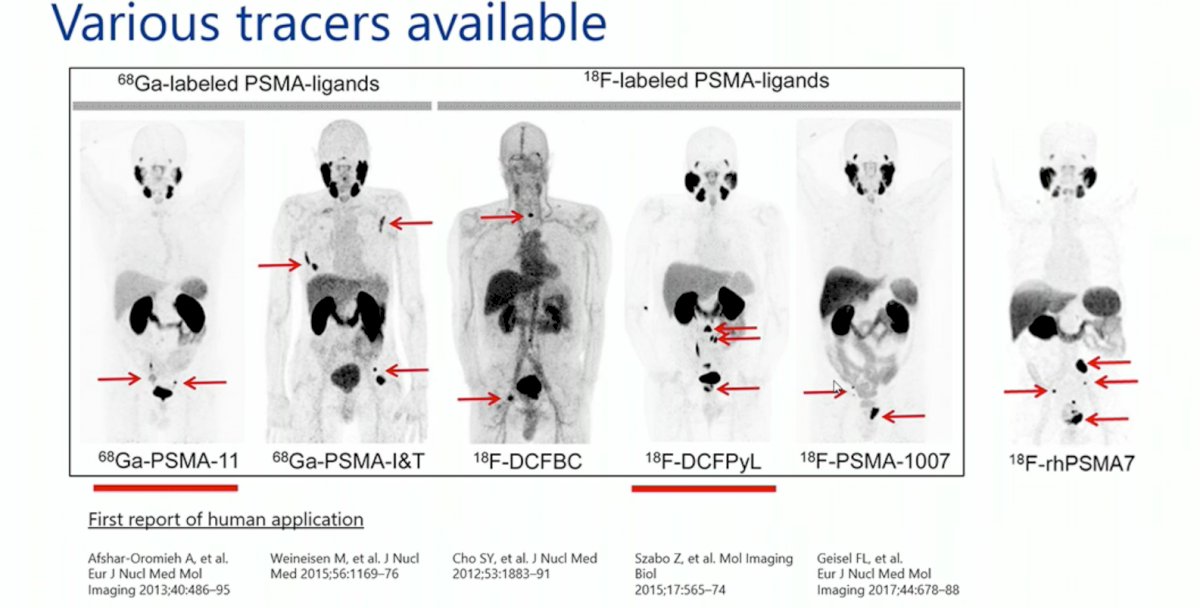 PSMA-PET/CT.jpg