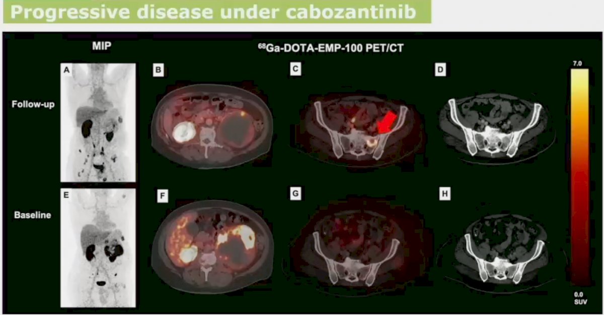 CABO progressive disease