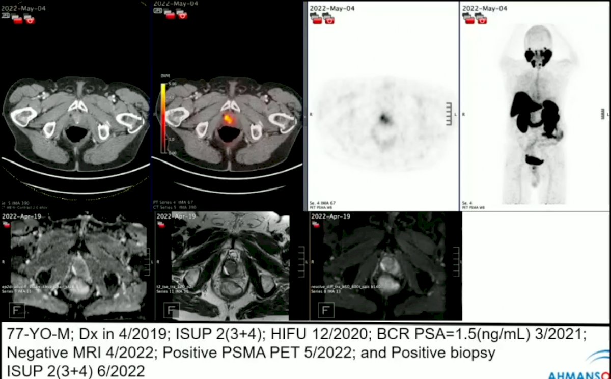 PSMA-PET/CT images