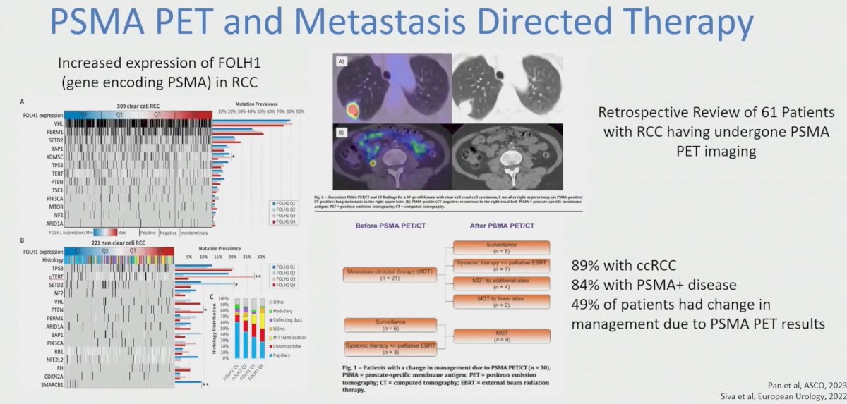 psma pet and mdt