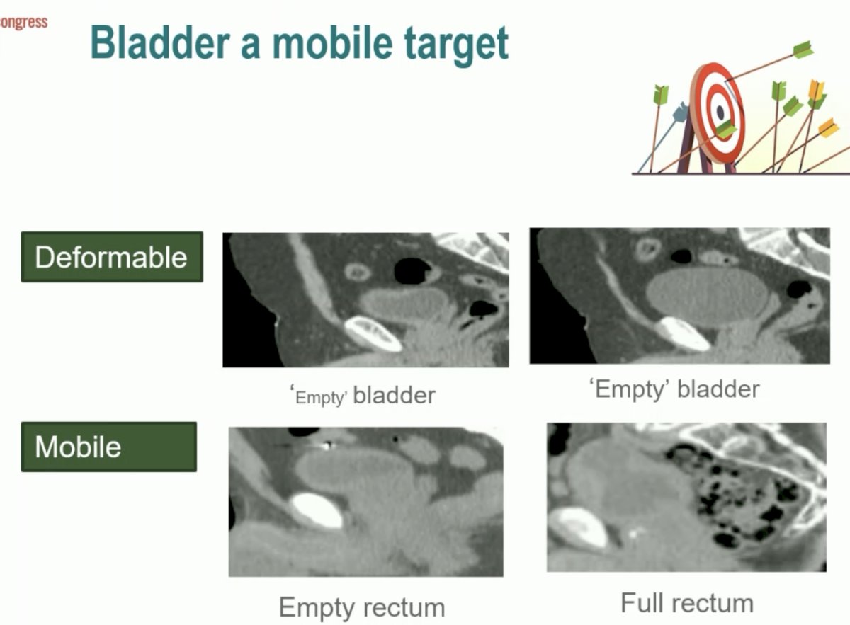 ESMO 2023 Huddart bladder preservation_3