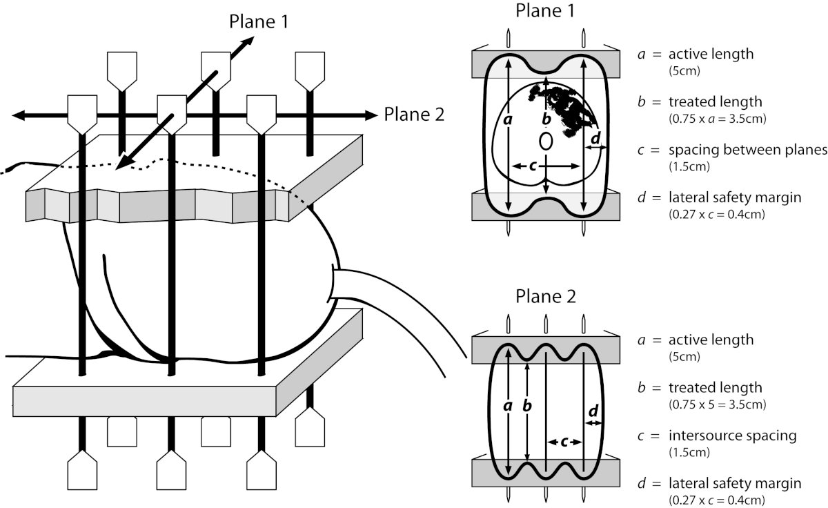 penile cancer Brachytherapy diagram