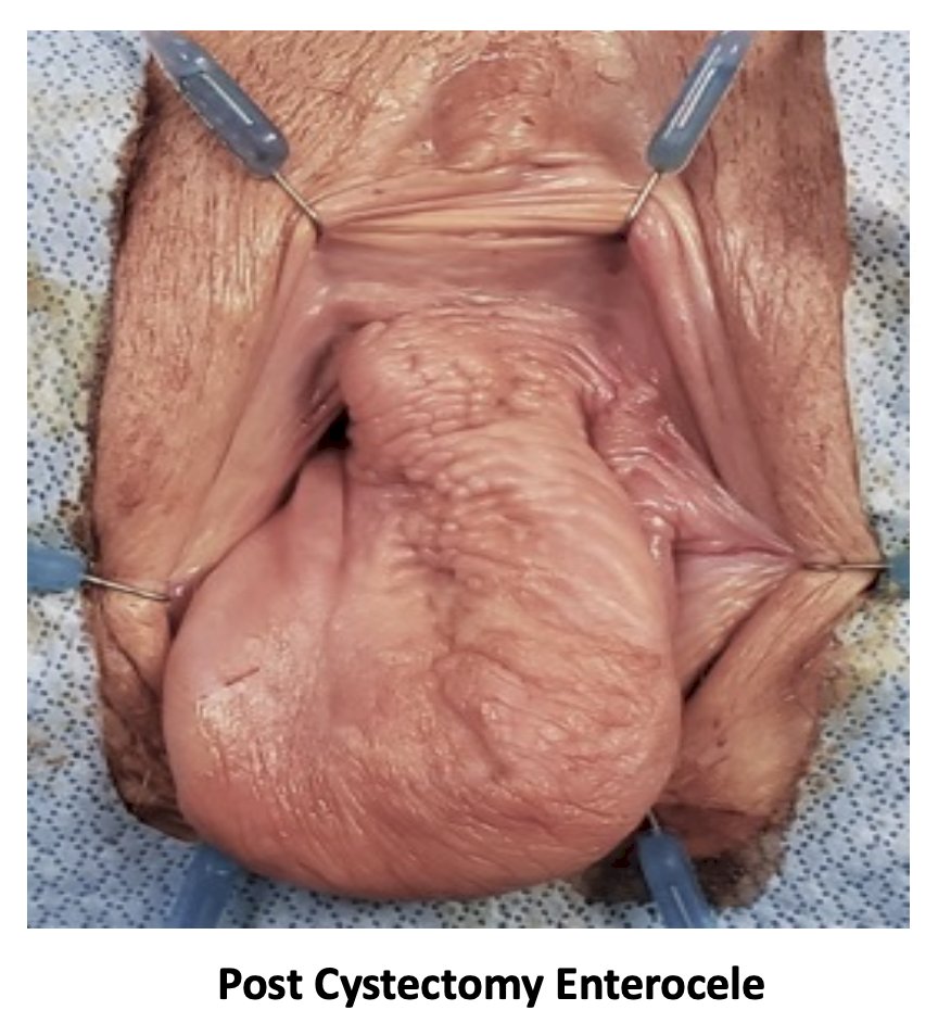 Post cystectomy enterocele