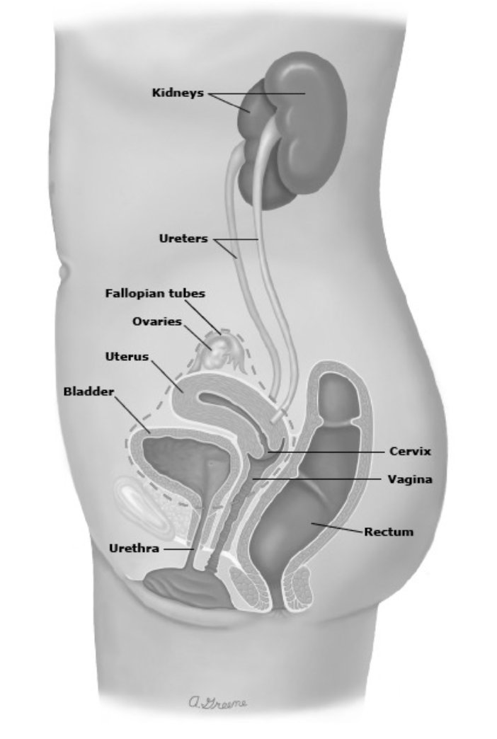 female cystectomy standard of care