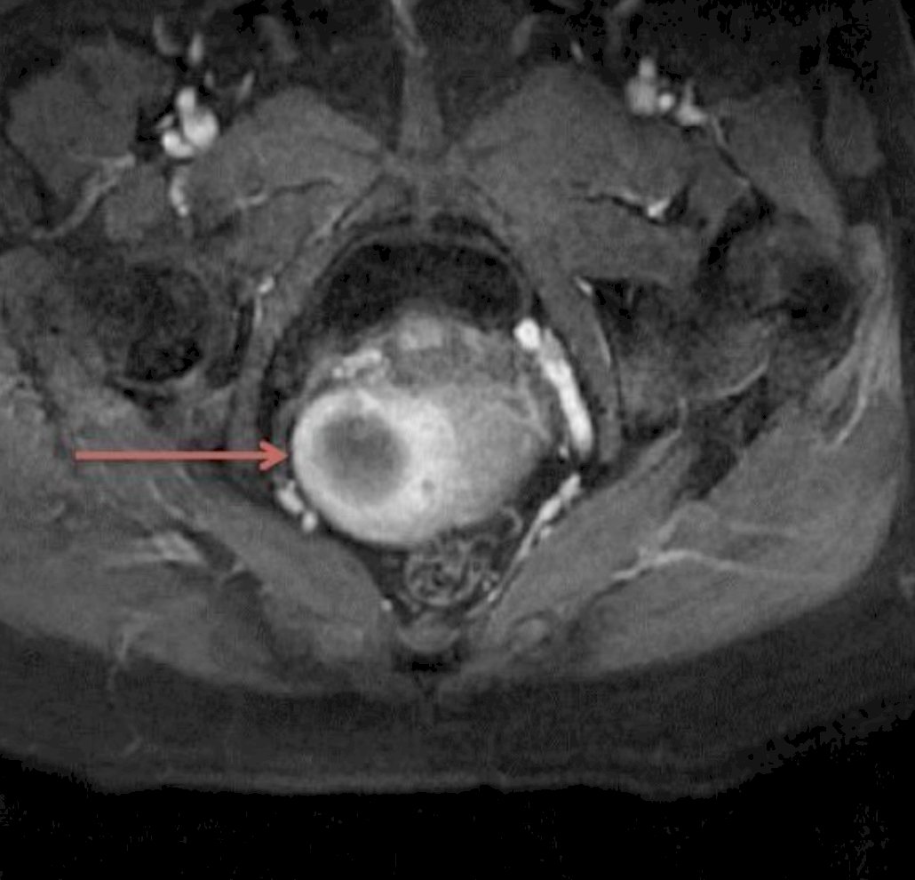 endometrial cancer screening image