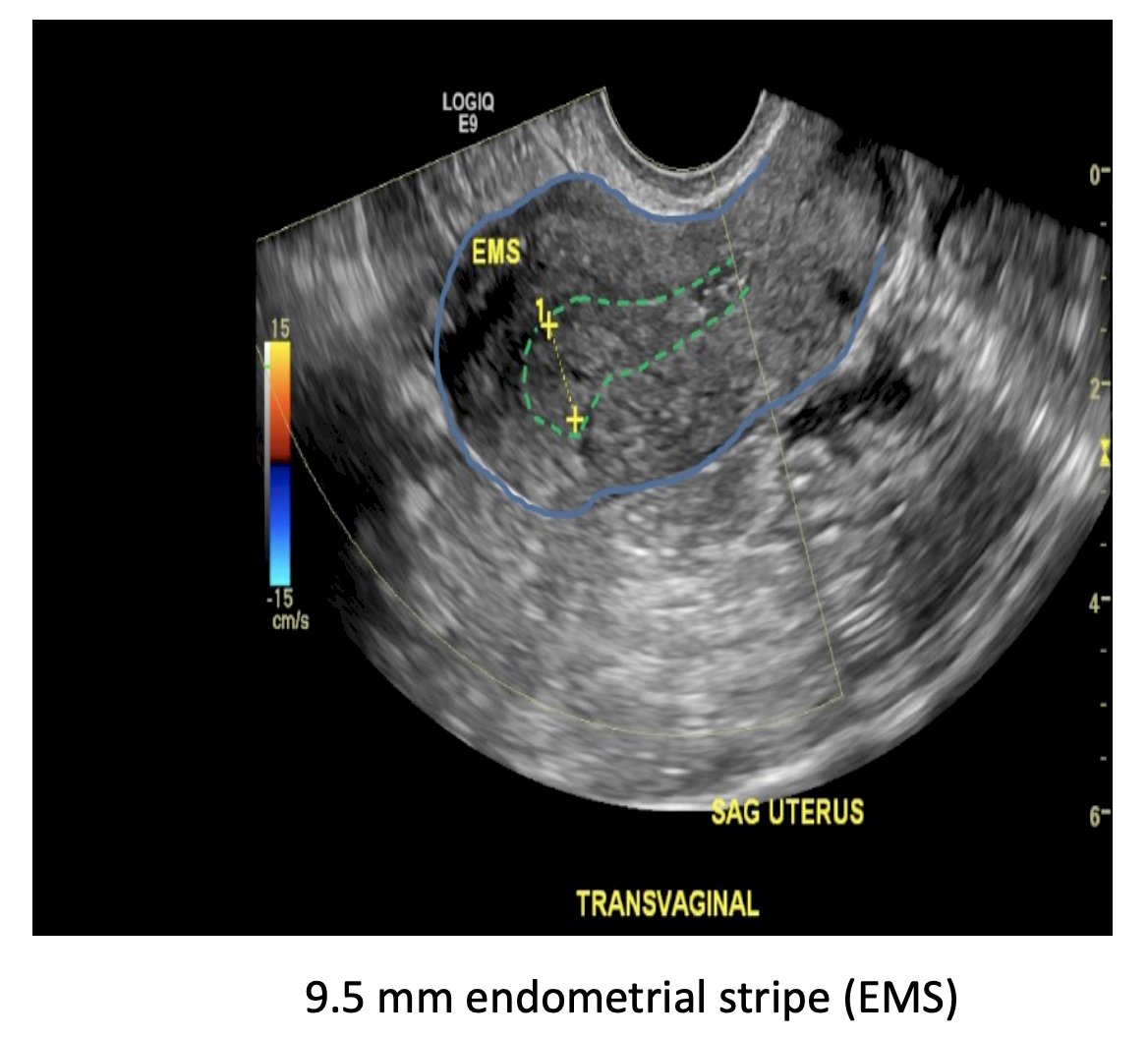 endometrial stripe image