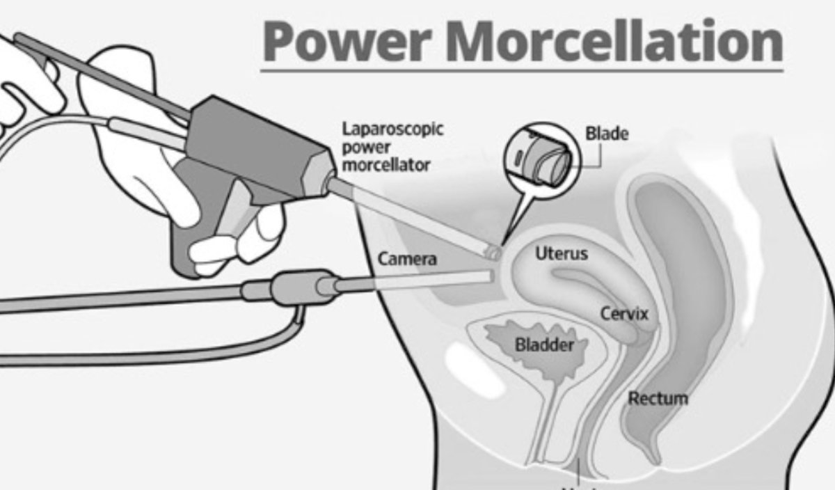  power morcellation during a laparoscopic hysterectomy