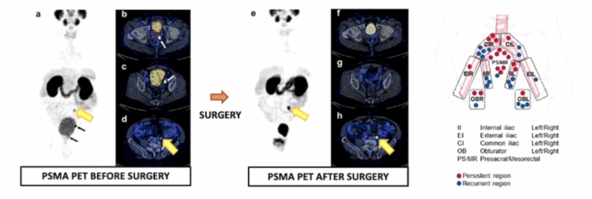 radioguided surgery for N1 disease by PSMA PET/CT