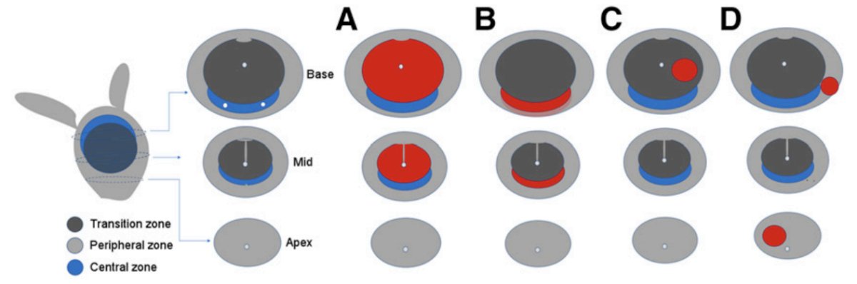 PSMA activity (diffuse transition zone (A), symmetric central zone (B), focal transition zone (C), and focal peripheral zone (D)
