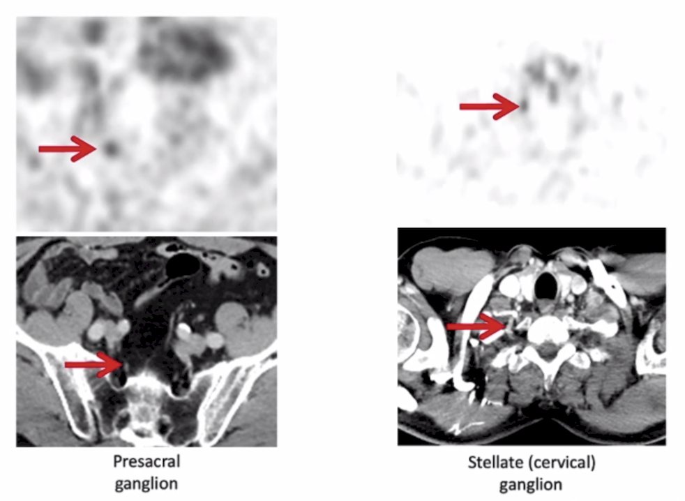 presacral ganglion and stellate (cervical) ganglion imaging