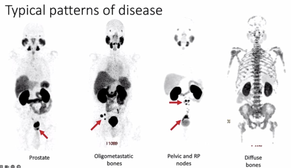 typical patterns of prostate cancer images