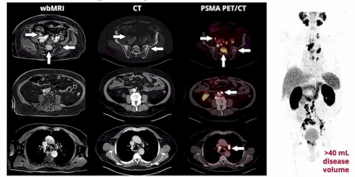 high risk prostate cancer (Gleason score 8, PSA 18 ng/ml) who had pelvic nodes and bone metastasis (low volume) on conventional imaging, who then had pelvic + retroperitoneal nodes + mediastinal nodes + bone metastasis (high volume) on PSMA PET/CT