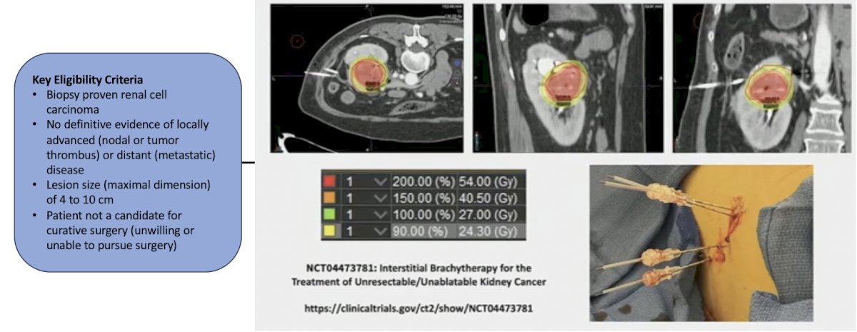 prospective study of interstitial brachytherapy for unresectable/unablatable T1/T2a renal masses