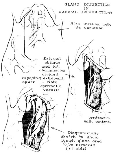 gland dissection in radical orchidectomy