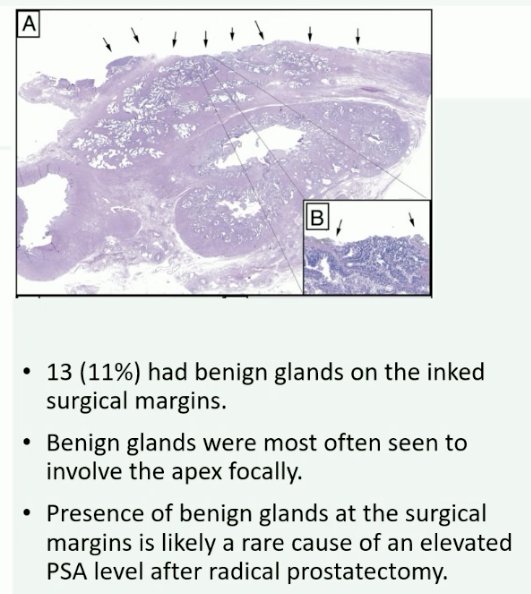 PSA persistence post-operatively is incomplete resection of the prostate, whereby benign glands may be left at the surgical margins leading to this laboratory finding
