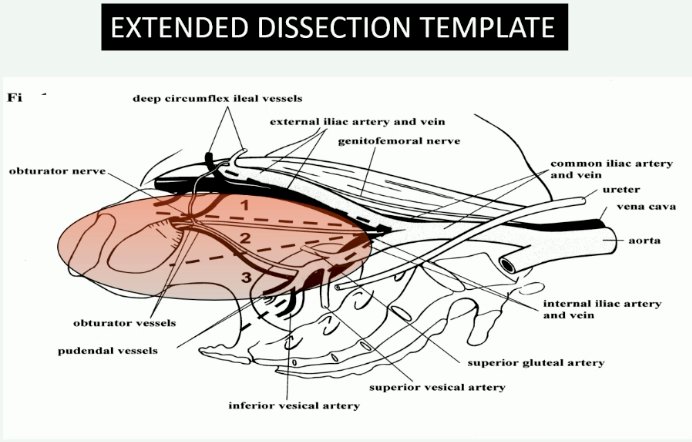 extended lymph node dissection