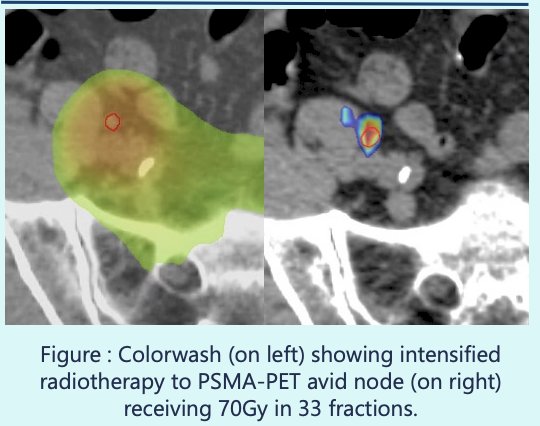 18F-DCFPyL PSMA-PET/CT prior to treatment